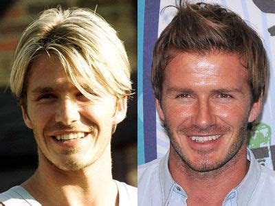 Dental Makeover Before and After Photo | David Beckham | Dental makeover, David beckham ...