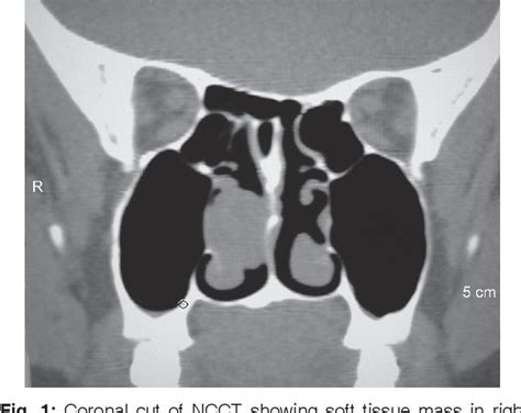 Figure 1 from Choanal Polyp Arising from Middle Turbinate | Semantic ...