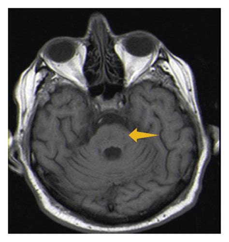 MRI images show central pontine T1 moderately hypointense areas (a), T2... | Download Scientific ...