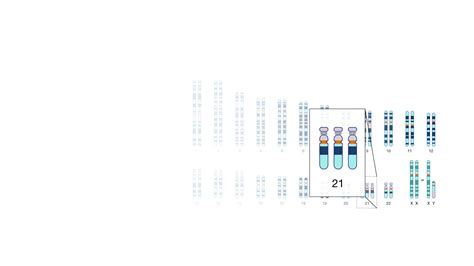 Down Syndrome (Trisomy 21)