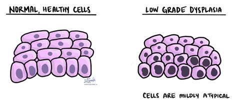 Laaggradige dysplasie | MyPathologyReport.ca