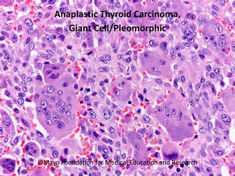 Anaplastic Thyroid Carcinoma - Mayo Clinic Proceedings