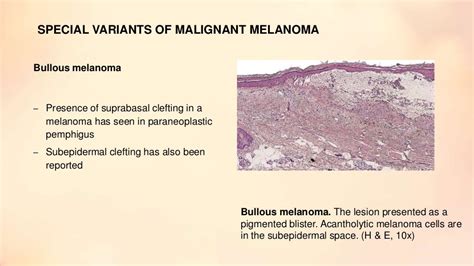 Melanocytic lesions. Pathology