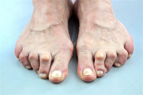Feet Of Woman Deformed From Rheumatoid Arthritis — Stock Photo © Hriana #49423005