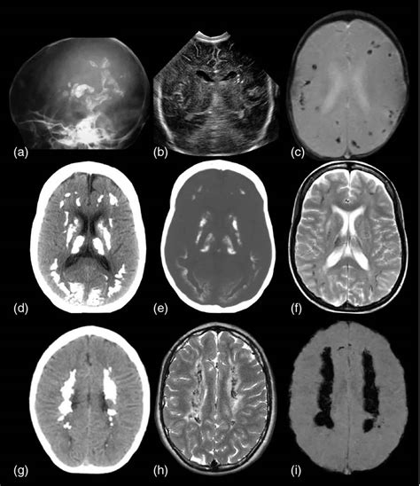 Calcification definition & calcification in arteries, heart, lungs, breast, kidney & brain