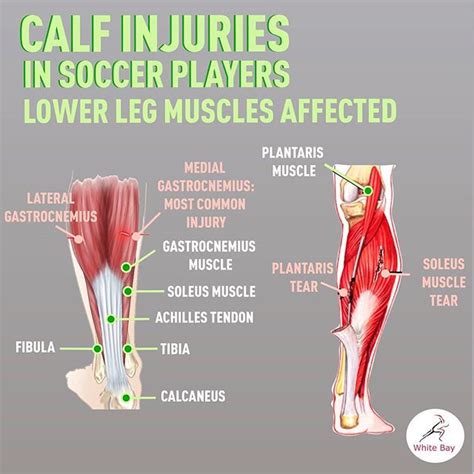 Do you keep pulling your calf ...? Learn more about Calf Muscle Injuries in Soccer Players