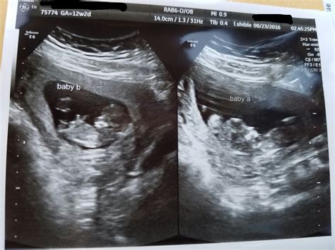 Surprised with identical twins at my 12 week ultrasound! : r/BabyBumps