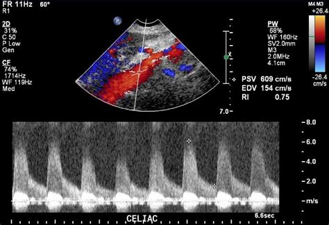 Vascular Image Challenge | Ultrasound, Vascular ultrasound, Celiac artery