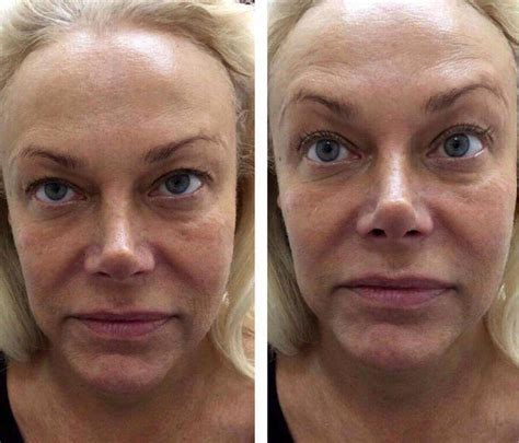 Facelift Hifu Smas Lifting Before And After » Facelift: Info, Prices, Photos, Reviews, Q&A