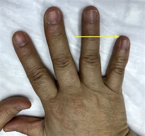 BRACHYDACTYLY | Hand Surgery Source