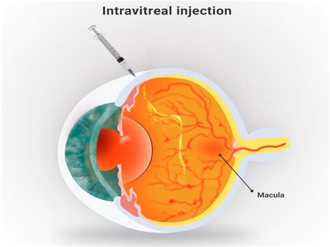 Syfovre (pegcetacoplan) to Treat Geographic Atrophy, USA