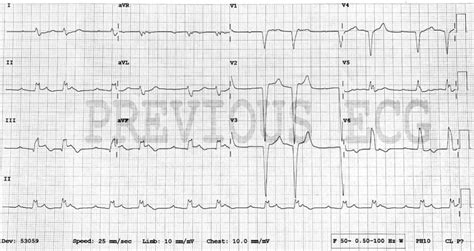 Sgarbossa Criteria • LITFL • ECG Library Diagnosis