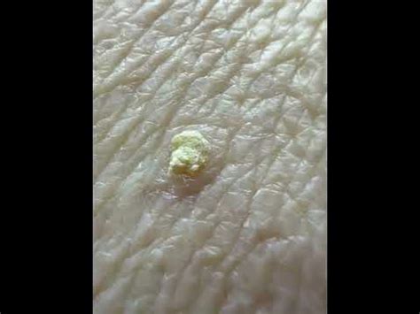 stucco keratoses - YouTube