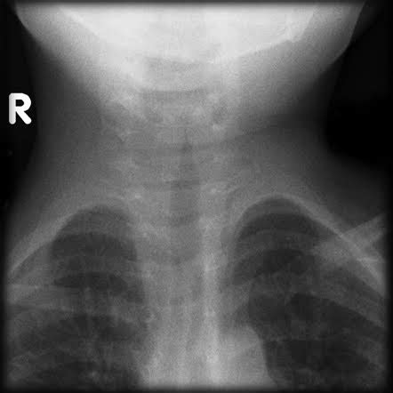 ON - RADIOLOGY: Croup (acute laryngotracheobronchitis) on X-ray with ...