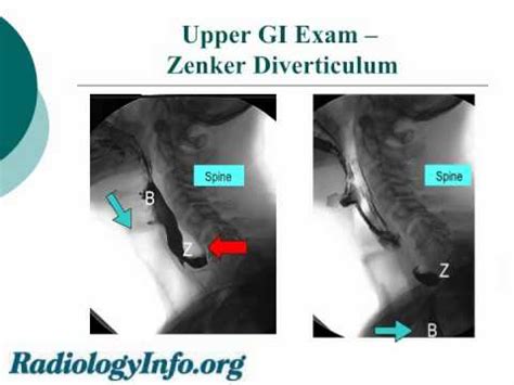 Upper Gi Series Ulcer