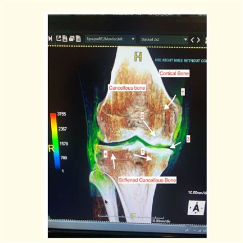 Order of arthritis in the knee joint from the concave side of the joint... | Download Scientific ...