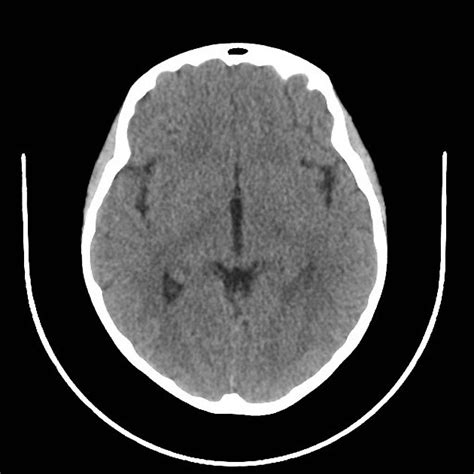 Superior Sagittal Sinus Thrombosis