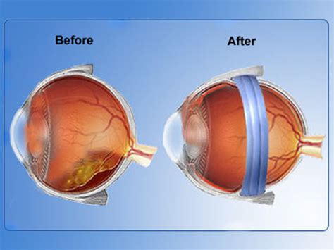 Cataract Surgery Cost in Kochi | Best Squint Treatment in Kochi