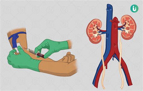 Kidney / Renal Function Test (KFT): Procedure, Purpose, Results, Normal ...