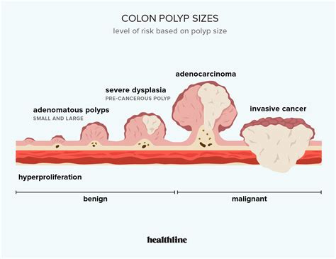 Colon Polyp Size and Type Charts