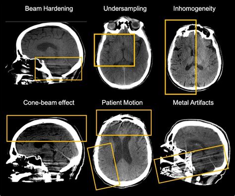 E-160 Detailed evaluation of brain cone-beam CT imaging artifacts: a prospective stroke series ...