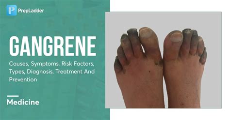 Gangrene: Causes, Symptoms, Risk Factors, Types, Diagnosis, Treatment and Prevention