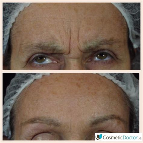 Before and After Photo Gallery | Cosmetic Doctor Dublin