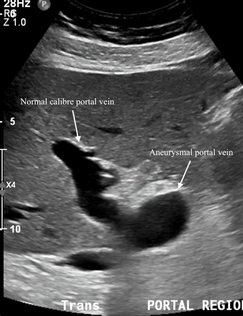 Portal venous aneurysm | BMJ Case Reports