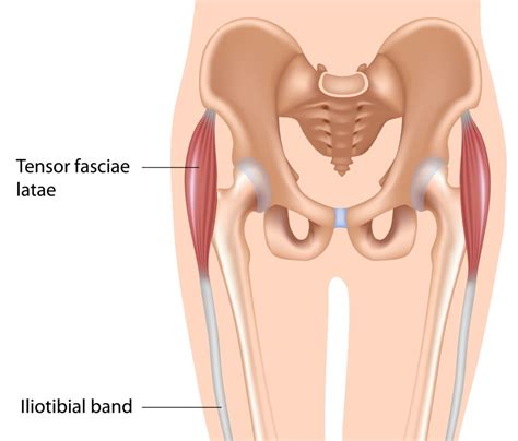 Tensor Fasciae Latae Pain: Causes, Symptoms, and Solutions