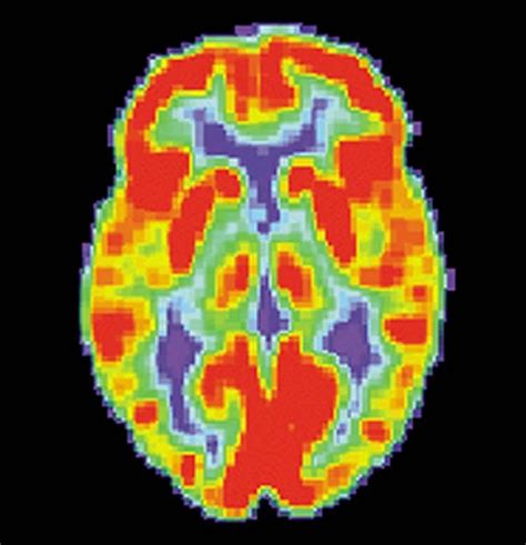 brain PET scan PTSD - Neuroscience News