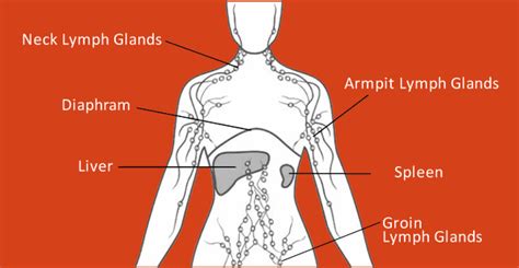 Lymphoma Neck : September is Hodgkin's Lymphoma Awareness Month: What ...