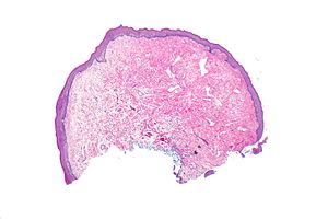 Oral fibroma - Libre Pathology