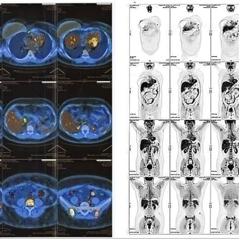 THE CT scan showing multiple solid lesions of the spleen. | Download ...