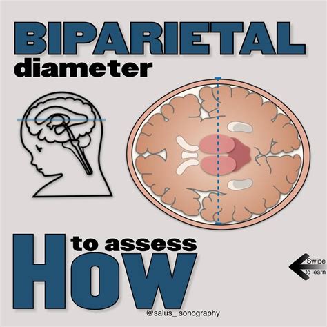 The biparietal diameter (BPD) was one of the first sonographic ...