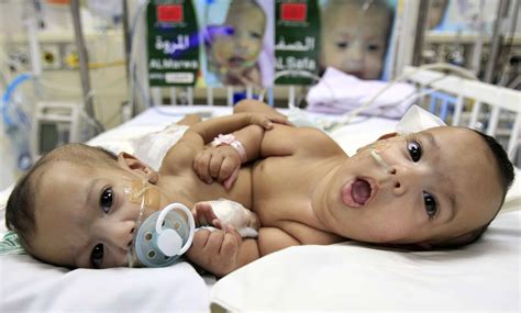 Conjoined twins born at San José hospital – The Tico Times | Costa Rica ...