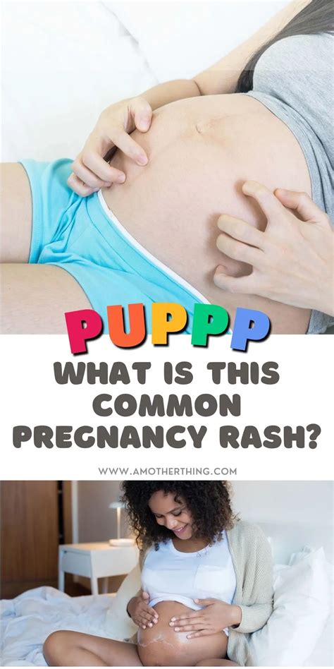 PUPPP Rash: Definition, Symptoms, Causes, & Treatment