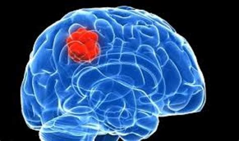 Brain Tumor, Symptoms, Types, Causes and Treatment | Mediologiest