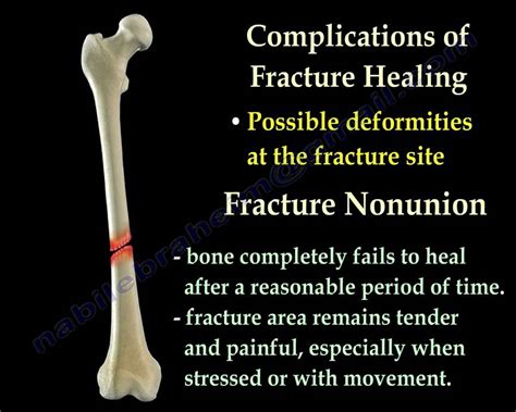 Fracture Healing Part 1 - Everything You Need To Know - Dr. Nabil Ebraheim - YouTube