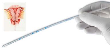 CooperSurgical - CooperSurgical 8200 Pipelle Endometrial Suction ...