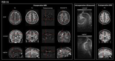 Ultrasonographic features of focal cortical dysplasia and their relevance for epilepsy surgery ...