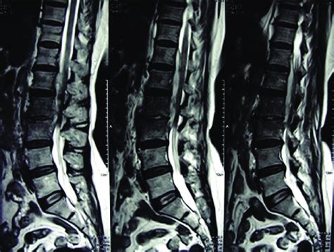 MRI of spine showing large anterior epidural abscess. | Download Scientific Diagram