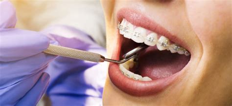 Dental Braces Treatment Details | Removal & Recovery