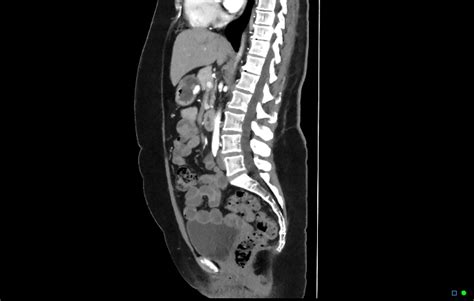 Normal CTA abdomen and pelvis | Image | Radiopaedia.org