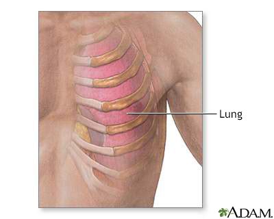 Costochondritis Information | Mount Sinai - New York