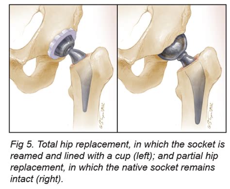 total hip replacement recovery stories - ridgel-clement