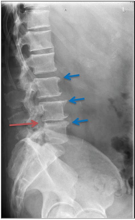 X-ray of the lumbar spine (lateral view) showing the anterior spurs in... | Download Scientific ...