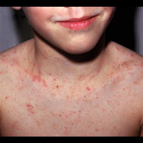 scabies on chest - pictures, photos