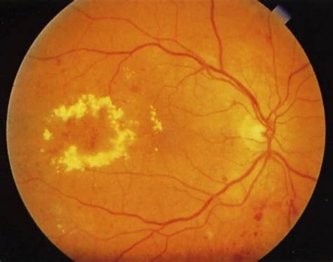 Edema macular ¿qué es y cómo se produce? | Miranza