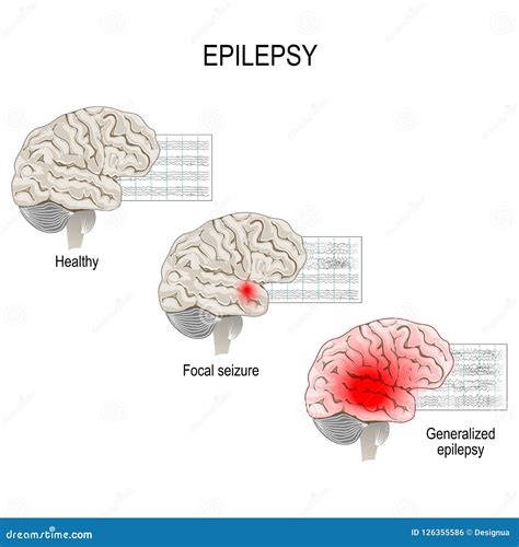 Epilepsy Brain Diagram