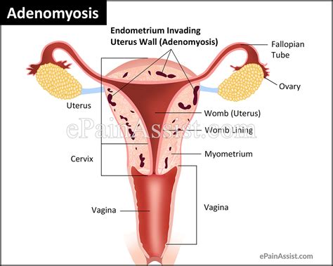 Adenomyosis|Causes|Signs|Symptoms|Treatment|Risk Factors|Diagnosis